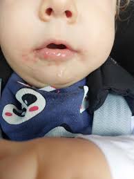 Hello everyone, is there anyone here with the junctional severe type of  LAMB3-related condition? I would like to ask how to manage blisters in the  throat? Are there any medications that can