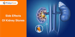Side Effects Of Kidney Stones Pristyn Care
