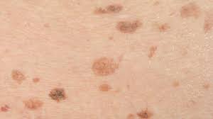 Yaitu mengatasi gatal di badan menggunakan obat modern dan menggunakan obat tradisional (secara alami). Inilah Cara Menghilangkan Bekas Gatal Menghitam Secara Alami Dan Medis