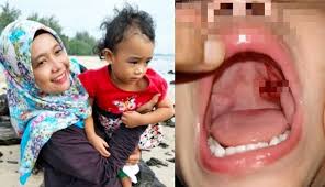 Keadaan ini tidak harus dipandang ringan kerana ia juga mungkin memberi petanda kepada penyakit lain. Ibu Menggigil Tengok Anak Kaku Lelangit Tertusuk Straw Mainan Darah Sampai Hidung Saya Silap Besar Doktor Kata Boleh Ragut Nyawa Alisha Viral Mstar