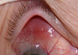 «die heilgymnastik in der gynaekologie: Lymphom Der Orbita Und Adnexe Oal Ocular Adnexal Lymphoma Elena Catalano 8 Ophtag St Gallen 31 05