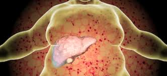 Check spelling or type a new query. Do You Have A Fatty Liver Scott D Isaacs Md Endocrinologist