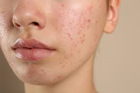 Image result for acne face