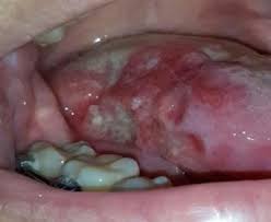 Image result for white cancer on tongue)