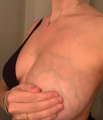 Prominent blue veins on boobs? (picture) - June 2020 Babies | Forums | What  to Expect | Page 2