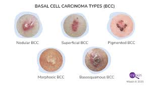 The tumors associated with this type of cancer are also typically large. Basal Cell Carcinoma Symptoms Types And Pictures