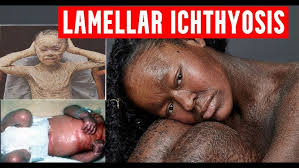 Image result for Ichthyosis