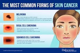 According to the american cancer society, just over 100,000 new cases of skin cancer are diagnosed in the united states each year. Skin Cancer Symptoms Causes And Natural Support Strategies