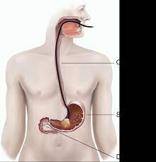 An endoscopy is a very safe procedure. Upper Gi Endoscopy And Colonoscopy Healthdirect