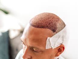 Essential Hair Transplant Aftercare for Optimal Recovery