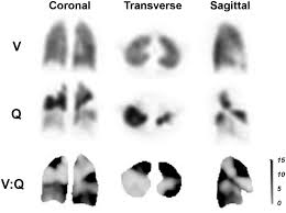 Image result for Ventilation Perfusion Scan