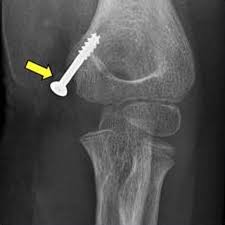 Although medial epicondylitis is referred to as golfer's elbow, it doesn't only affect golfers. Medial Epicondyle Avulsion Fracture With Joint Entrapment In Children