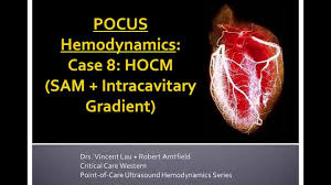 Image result for Left Ventricular Outflow Obstruction