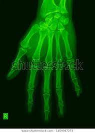 Manus X Ray Anatomy Radiology Radiographic Stock Photo Edit Now 1459397273 Radiology X Ray Photo Editing
