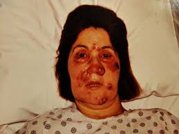 Beware Of Hospital Mistakes : RIP Evelyn Ruth Miles 2018