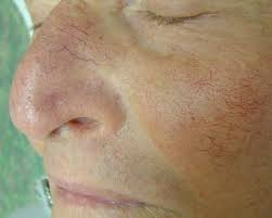 Maybe you would like to learn more about one of these? Behandlung Von Besenreisern Und Gefassveranderungen Laserpraxis Dr Brigitte Hartman Emmendingen