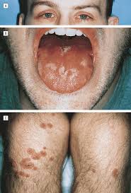 Image result for Erythema Multiforme Major