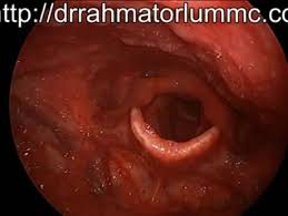 Image result for Functional Aphonia