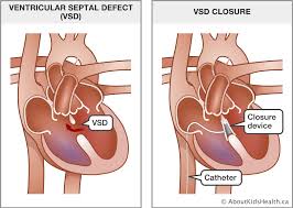 Image result for Ventricular Septal Defect