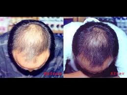 Argan oil for hair is often called golden liquid. Argan Oil Hair Regrowth Youtube