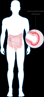 Was Passiert Im Korper Bei Colitis Ulcerosa Ced Trotzdem Ich De