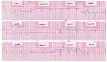 Image result for ECG 12 Channel