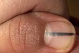 Image result for Akutní zánět nehtového lůžka