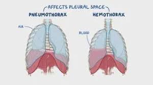 Image result for Pneumothorax