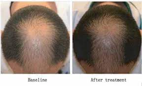 Before we go any further, let me just put this out there. Microneedling For Hair Loss What S The Best Needle Length It Depends