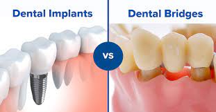 Dental bridges are cemented or fixed in the mouth, and involve at least three crowns connected together to fill the space of the missing tooth. Dental Implants Vs Bridges Finding What S Best For You Absolute Dental