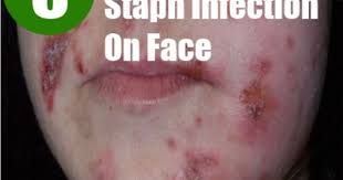 5 Common Symptoms Of Staph Infection On Face Home Health Remedies Staph Infection Face Home