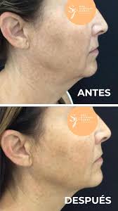 Si estás buscando un tratamiento no invasivo para rejuvenecer y tonificar  tu piel, el Endolifting es la solución ideal. En la clínica de la Dra.  Stephany Gómez, este procedimiento avanzado utiliza ...