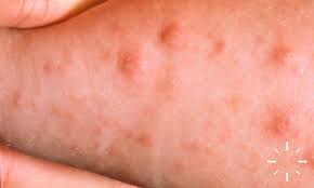 Image result for scabies bite