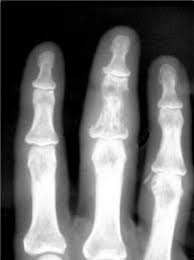 Falange proximal