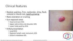 The earlier a skin cancer is diagnosed, the easier it is to treat. Merkel Cell Carcinoma From Diagnosis To Treatment Youtube