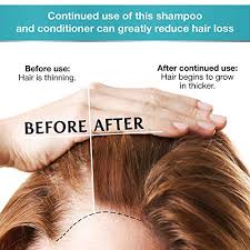 Best supplements for hair growth and thickness. Review For Biotin Shampoo And Conditioner For Hair Growth Thickening Anti Hair Loss Shampoo Treatment Regrowth Shampoo Conditioner For Dry Normal Oily Color Treated Hair