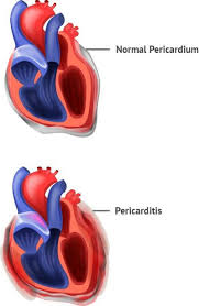 Image result for Pericarditis