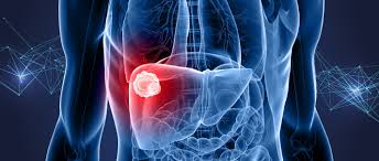 Liver cancer | What causes liver cancer? | WCRF International
