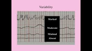 Electronic Fetal Monitoring Crash Medical Review Series Youtube