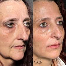 💉 Peri-Oral Rejuvenation + Lip Filler