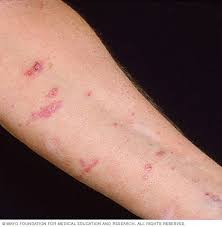 Pictures of oral lichen planus, on tongue, hands, legs, feet, skin, scalp, face, nails, gum. Lichen Planus Symptoms And Causes Mayo Clinic