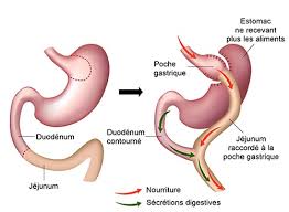 Apres bequem und günstig online bestellen. Technique Du Bypass Gastrique Chirurgie Obesite Pres D Aix En Provence