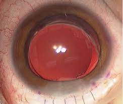 Eyeworld Through The Eyes Of A Child Post Op Astigmatism Resolves With Time