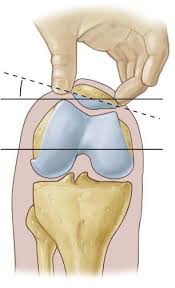 Image result for Patellar Tilt Test