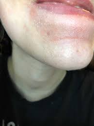 Comedones mistaken for acne it's highly common for people (mainly dermatologists) to mistake this condition for acne. Closed Comedones Beauty Insider Community