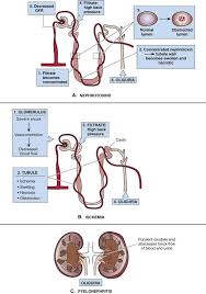 Acute Renal Failure With Images Acute Renal Failure Renal Renal Failure