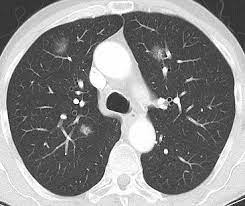 Die Vielen Gesichter Der Pneumonie Healthcare In Europe Com
