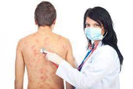 Prezint aici simptomele avute și tratamentul prescris. Varicela La AdulÅ£i Simptome ComplicaÅ£ii Si Tratament Dcnews
