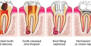 Read Full Procedural Details Of Root Canal Here It Is A Good Way To Treat Your Paining Tooth Without Getting I Dental Fillings Root Canal Treatment Root Canal