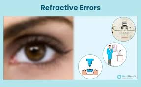 Image result for Refractive Error